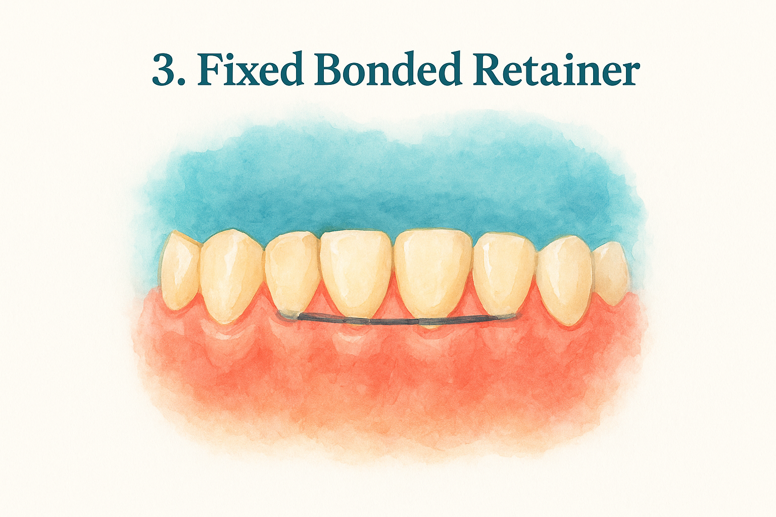 3. Fixed Bonded Retainer