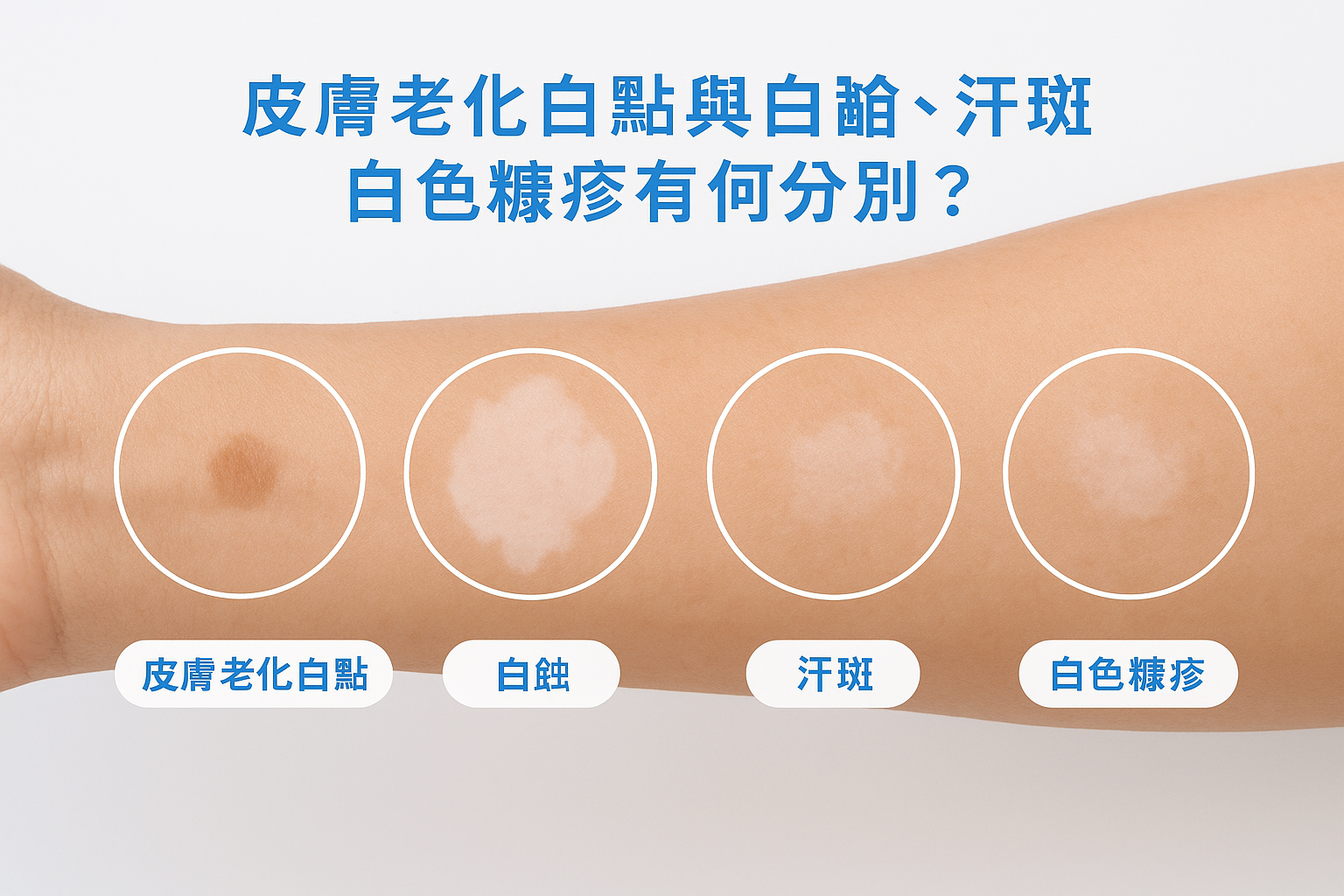 皮膚老化白點與白蝕、汗斑、白色糠疹有何分別？