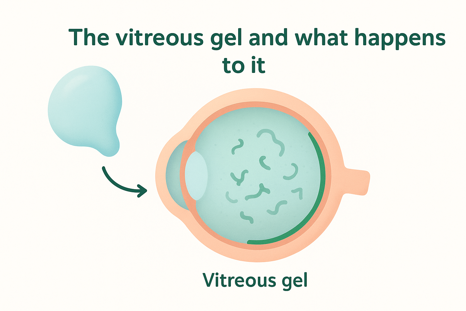 The vitreous gel and what happens to it