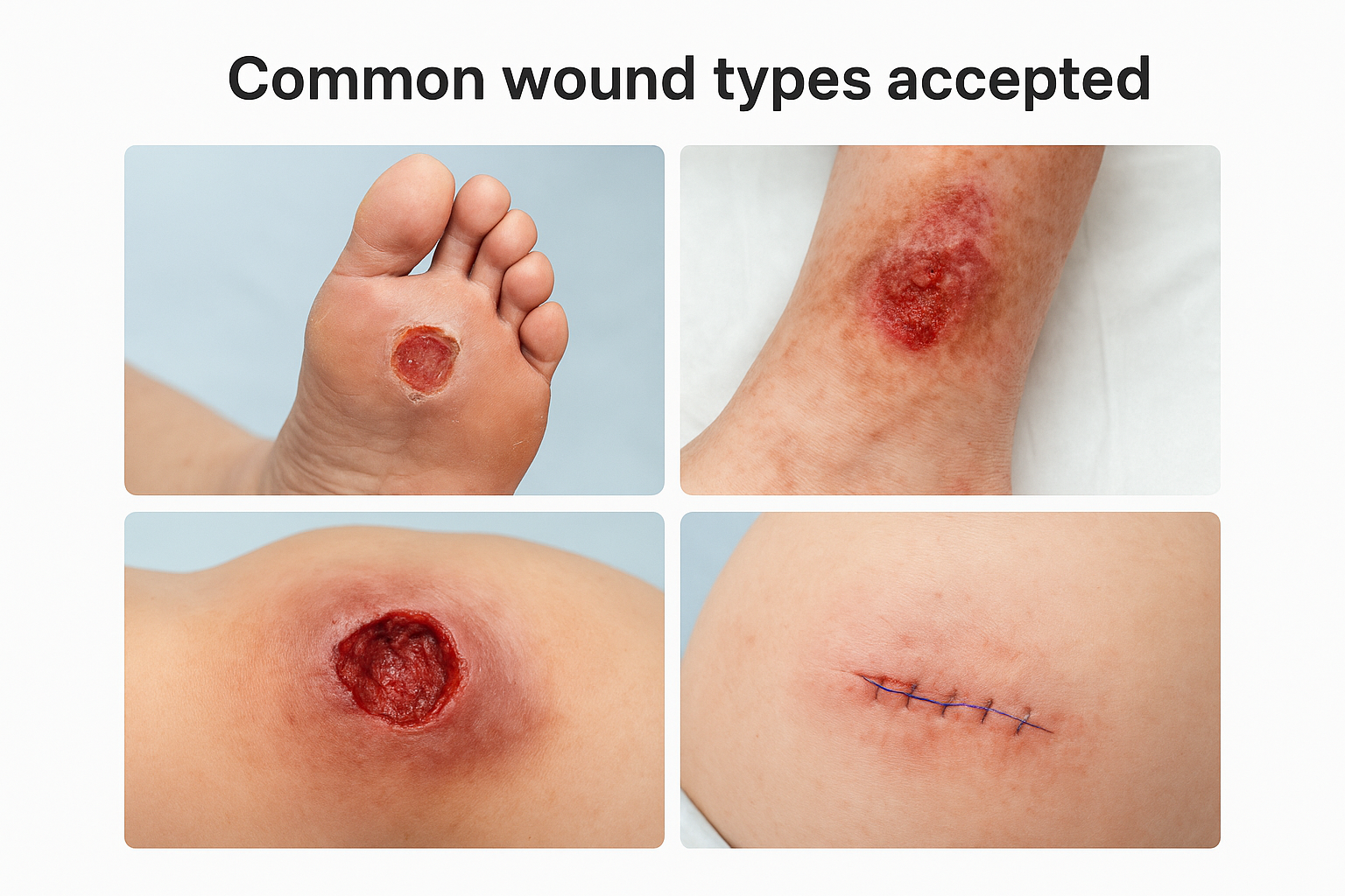 Common wound types accepted